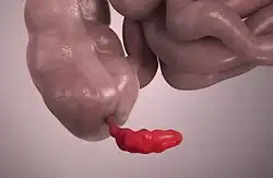 3D still showing appendicitis.