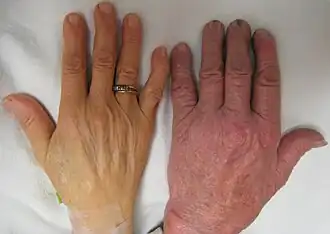 Image of two light-skinned hands. Left hand appears pale and yellow and wearing a ring on the ring finger. Right hand appears pinkish.
