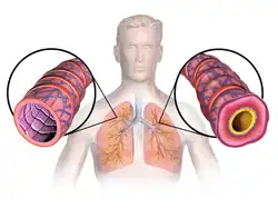 Diagram of asthma