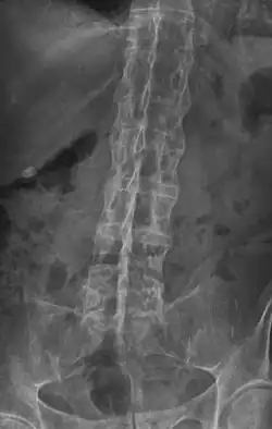X-ray showing "bamboo spine" in a person with ankylosing spondylitis