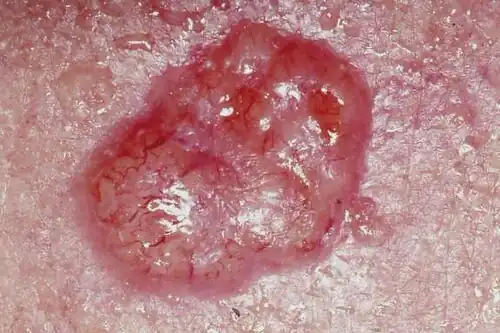 Basal cell carcinoma on the patient's back