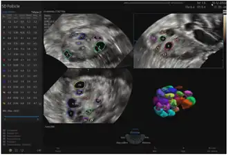Three ultrasound images at different locations in the ovary (different planes), and a reconstructed 3D image of ovarian follicles.