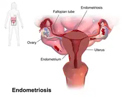 Image of uterus (womb), ovaries and bowels in the background. Endometriosis lesions are seen on the outside of the uterus, on the bowels and on the outside of the ovaries