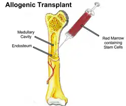 Illustration labeled "Allogenic transplant" showing the femur with a large needle puncturing into the medullary cavity to harvest red bone marrow containing blood stem cells