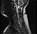 MRI scan of cervical disc herniation between C6 and C7 vertebrae