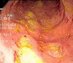 Endoscopic image of Crohn's colitis showing deep ulceration