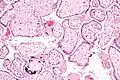 Micrograph of CMV placentitis
