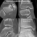 CT scan and projectional radiography of a case of osteochondritis dissecans of parts of the superior-medial talus.