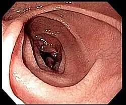 Endoscopic image of the intestines of an individual with coeliac disease