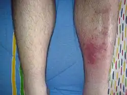 Redness and mild swelling of an adult leg