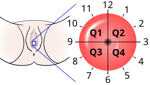 The location of cervical cancer can be described in terms of quadrants, or corresponding to a clock face when the subject is in supine position.