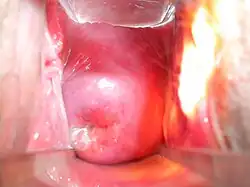 A adult woman's cervix viewed through vagina using a vaginal speculum