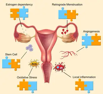 diagram showing the 'puzzle pieces' of endometriosis mechanisms
