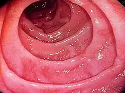 An endoscopy of the intestines