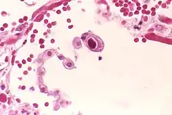 Typical "owl eye" intranuclear inclusion indicating CMV infection of a lung pneumocyte