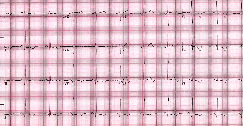 ECG showing HOCM