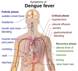 Outline of a human torso with arrows indicating the organs affected in the various stages of dengue fever