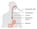 Internal radiotherapy for esophageal cancer