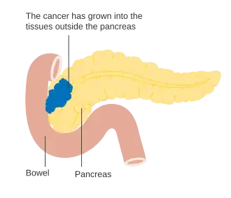 Stage T3 pancreatic cancer