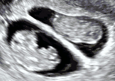 Dichorionic–diamniotic twins at eight weeks and five days since co-incubation as part of IVF. The twin at left in the image is shown in the sagittal plane with the head pointing towards upper left. The twin at right in the image is shown in the coronal plane with the head pointing rightwards.