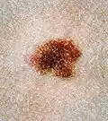 Atypical nevus