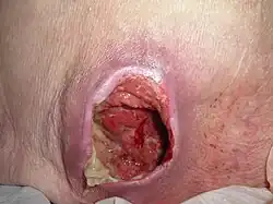 A large ulceration of the lower back with complete loss of the overlying skin