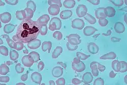 Microscopic view with Giemsa stain of a blood smear with abnormally small, pale red blood cells