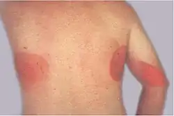 Large red patches of skin on the back and arm from multiple prolonged electrophysiological and ablation procedures with bi-plane fluoroscopy