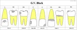 Chart showing digitally drawn images of caries locations and their associated classifications.