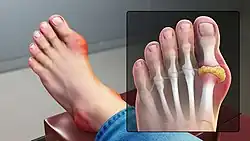 A medical illustration showing the joint of the big toe being affected by gout