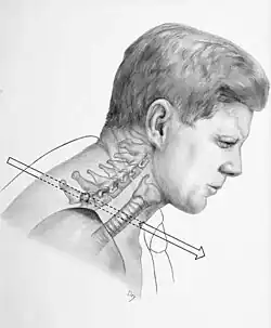 A sketch shows an arrow illustrating the first bullet that struck John F. Kennedy. The bullet is seen entering his neck and exiting his throat