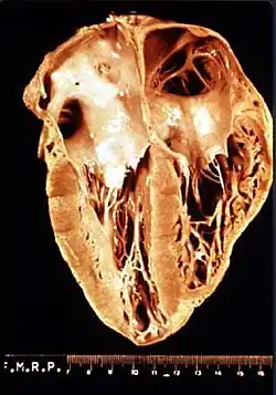 Photograph of a heart showing perforation of the walls