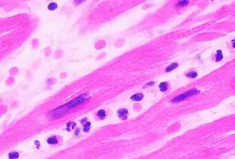 Neutrophils are seen in a myocardial infarction at approximately 12–24 hours,[68] as seen in this micrograph.