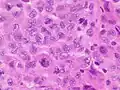 Anaplastic tumor cells