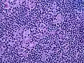 Hodgkin lymphoma, nodular lymphocyte predominant (high-power view): Notice the presence of L&H cells, also known as "popcorn cells" (H&E).