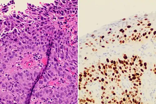 Invasive cervical squamous cell carcinoma on H&E histopathology and Ki-67 immunohistochemistry. The latter correlates well with the degree and level of dysplasia.[84]