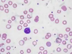 Microscopic view with H&E stain of a blood smear with abnormally small, pale red blood cells
