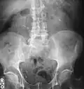 Bilateral kidney stones can be seen on this KUB radiograph. There are phleboliths in the pelvis, which can be misinterpreted as bladder stones.