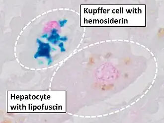 Prussian blue staining, highlighting the hemosiderin pigment as blue.
