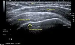 Longitudinal ultra sonography of the supraspinatus tendon