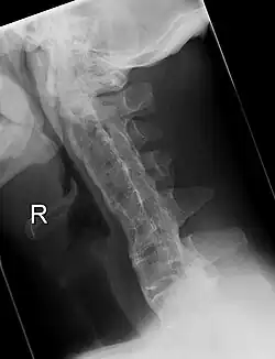 Cervical spine showing ankylosis (fusion)