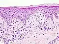 Melanoma in skin biopsy with H&E stain – this case may represent superficial spreading melanoma.