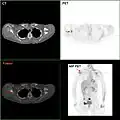 F-18 FDG PET/CT: A breast cancer metastasis to the right scapula