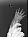 X-ray image of human infant left hand.