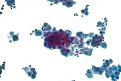 Micrograph of a pleural fluid cytopathology specimen showing malignant mesothelioma, one cause of a pleural effusion