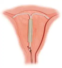 a hormonal coil placed in the womb.