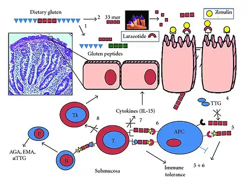 Visual graphic describing the mechanisms of coeliac disease within the intestines