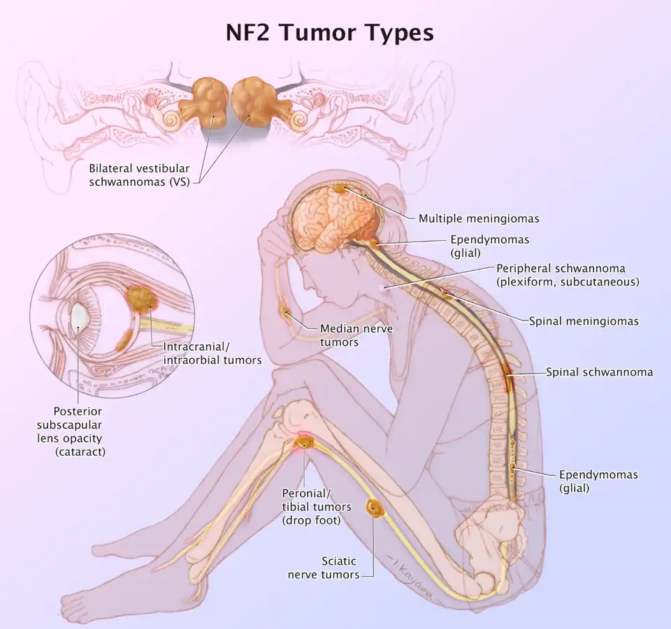 Figure of various morbidities associated with neurofibromatosis type II.[13]