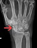 Severe osteoarthritis and osteopenia of the carpal joint and 1st carpometacarpal joint