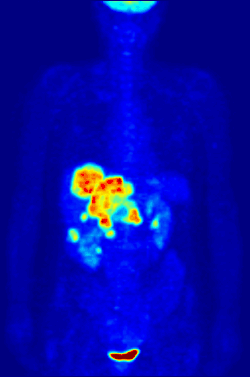 Maximum intensity projection (MIP) of a whole-body positron emission tomography (PET) acquisition of a 79&nbsp;kg female after intravenous injection of 371&nbsp;MBq of 18F-FDG (one hour prior measurement).